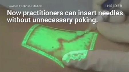 这个黑科技能照亮你的血管，让护士好好地给你扎针！