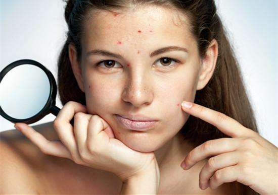 祛痘祛痘印最有效的方法小妙招,教你五种最有效的祛痘印方法
