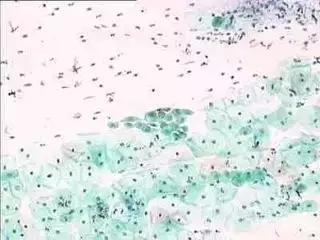 宫颈巴氏涂片和tct哪个准,宫颈癌筛查到底做tct还是hpv