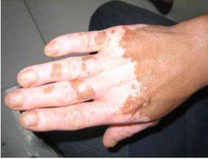 治疗白癜风最好的12副药,白癜风老中医快速治疗对话