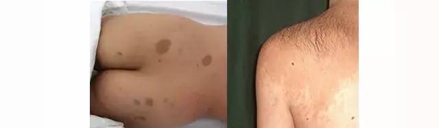 初生婴儿痣和胎记怎么区别,孩子长痣和胎记区别