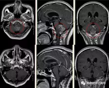 畸胎瘤的症状及治疗方法,五厘米的畸胎瘤有什么症状