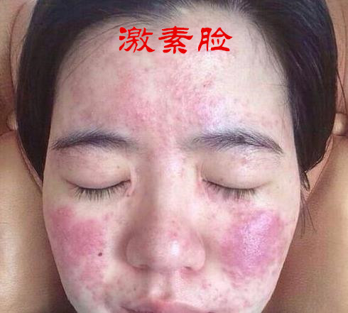 什么是激素脸症状怎么治疗,什么叫做激素脸有哪些症状
