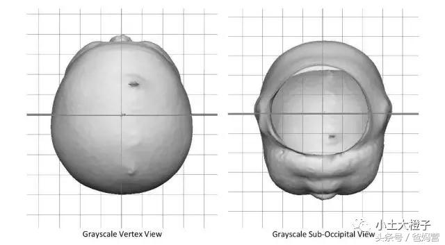 美国的宝宝扁头为什么要矫正,扁头在国外要做矫正吗