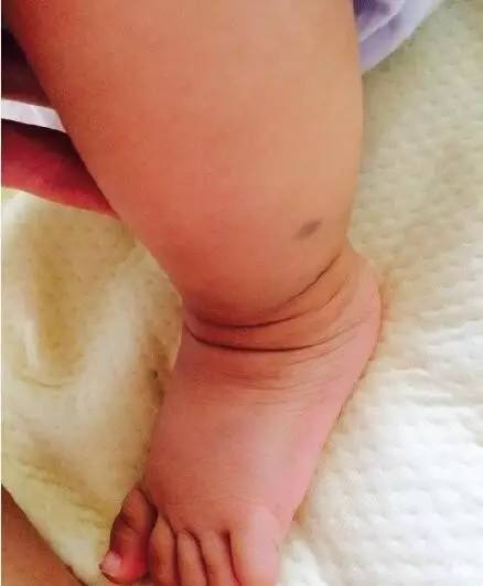 初生婴儿痣和胎记怎么区别,孩子长痣和胎记区别