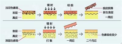 激光去斑哪种斑最好去,药水点斑和激光点斑哪个好