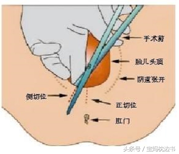 为什么医生不建议剖腹产顺产,宁可剖腹产也不用产钳