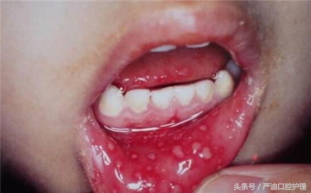 牙套导致口腔溃疡最快解决方法,戴牙套口腔溃疡最快解决的方法