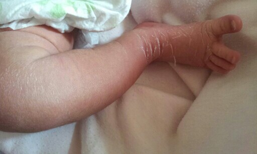 新生儿身上脱皮还会长痘吗,新生儿10天身上脱皮