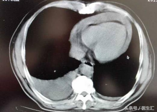 肺部心包积液是什么原因引起的,主动脉夹层心包积液是怎么回事