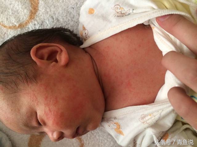 婴儿颈部出现红疹子该怎么办,颈部有红疹子用什么药好得快