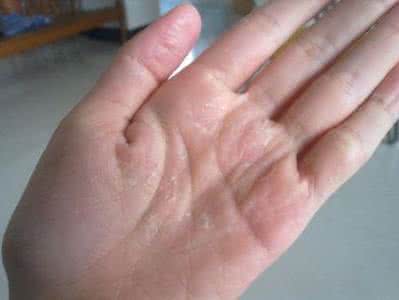 皮肤瘙痒脱皮是什么原因,双手瘙痒是什么原因引起的