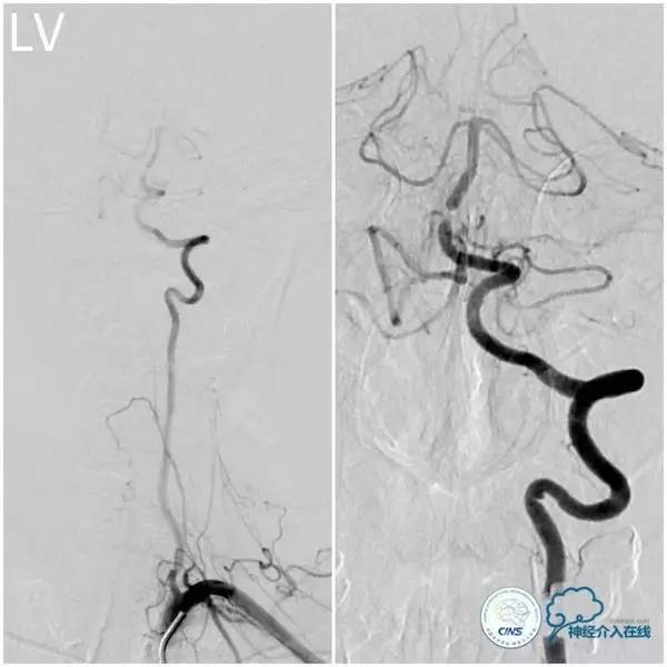 天坛周记,天坛医院脑动脉狭窄