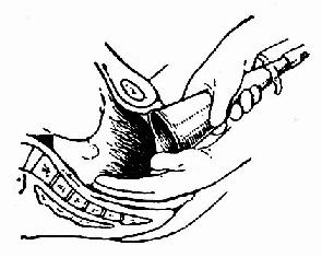 第6版妇产科护理学,第71课