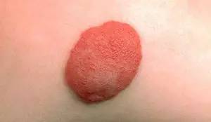 宝宝身上很多痣,宝宝身上的痣有母痣