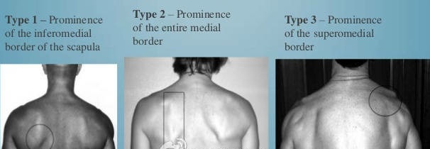 翼状肩胛骨可以练肩背吗,肩胛骨突出改善练习