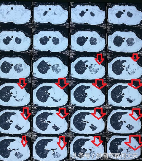 72岁老爷子，肺癌晚期，喘不上气，经这么一治疗竟然好多了