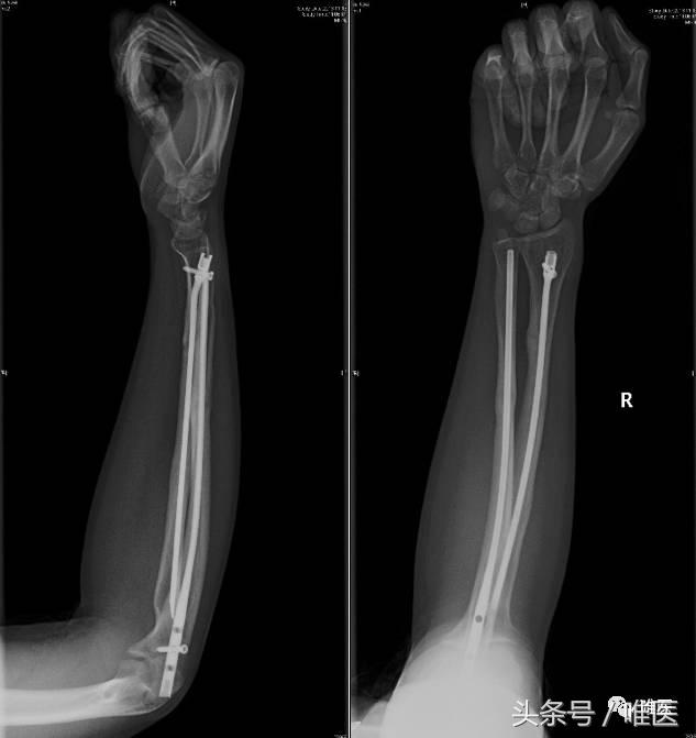 肱骨髓内钉的手术体位,肱骨髓内钉术后康复恢复步骤