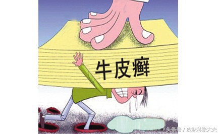 牛皮癣如何防止加重,牛得牛皮癣怎么治疗能彻底根除