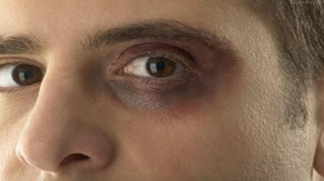 女人眼圈发黑重大疾病,眼圈发黑需警惕