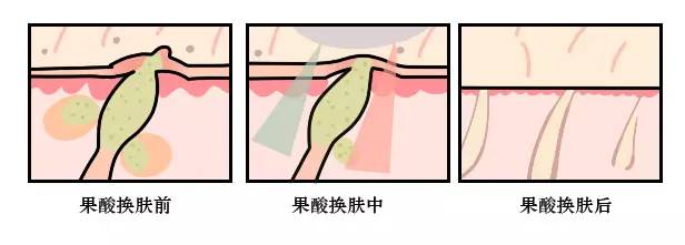 背上痘痘夏天怎么穿吊带,背后长痘痘怎么穿小吊带