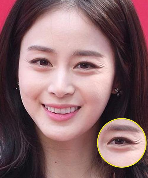 因为爱笑眼角皱纹比较多怎么办,爱笑的女孩有笑纹怎么办