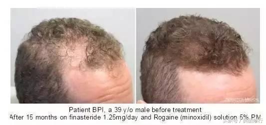 掉头发严重防脱洗发水有用吗,掉头发用防脱的洗发水有效果吗