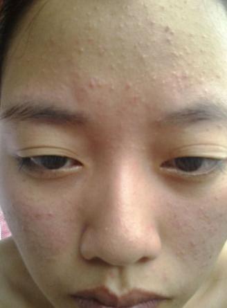 祛痘很多次都不见效,祛痘一瓶搞定