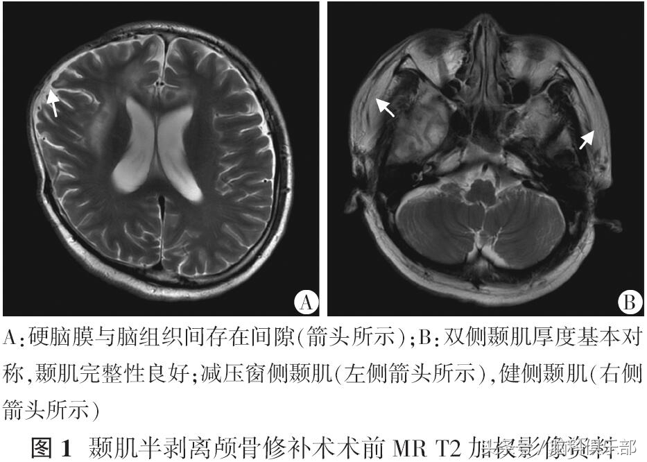 颅骨修补术中需要剥离颞肌吗,颞骨修补手术
