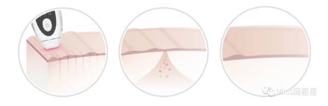 iluminagelaser美容仪,紧致去皱美白美容仪