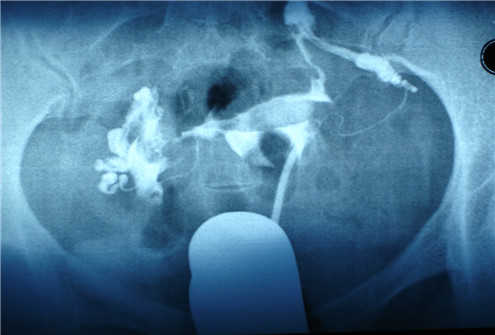 节育环多久才会陷进肉里,节育环多久会出现嵌顿