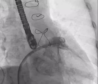 「病例」80岁房颤患者抗凝治疗后反复咯血，咋办？