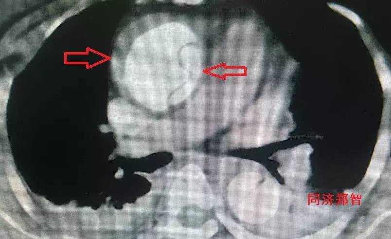 主动脉夹层差点要了老公的命,主动脉夹层兄妹