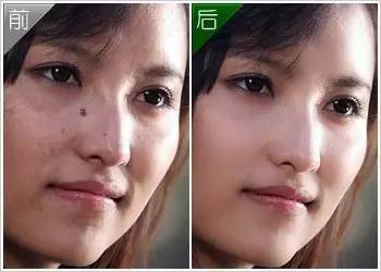 身上长痣小心癌变,身上的痣会癌变吗