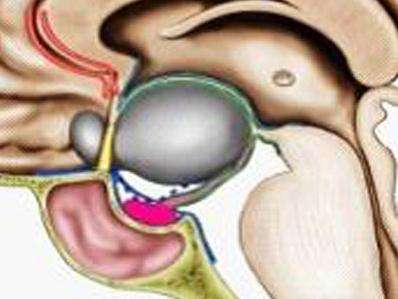 小孩颅咽管瘤真实治愈率,颅咽管瘤算不算重大疾病