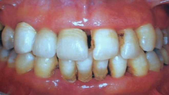 牙齿缝隙越来越大能矫正吗,洗牙会让牙齿缝隙越来越大吗