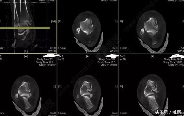 脚踝十年前扭伤现在肿痛什么原因,脚踝扭伤肿痛多少个小时可以擦药