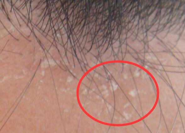 头皮上有一层厚厚的白色的头皮屑,头皮上有一层白色的头皮屑