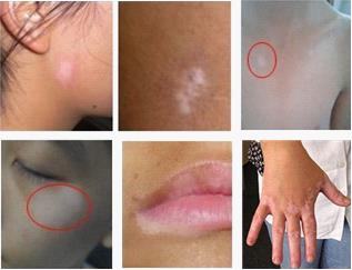 白癜风如果不治疗有什么危害,白癜风不治疗有什么危害呢