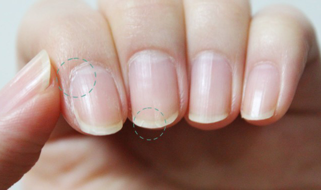 指甲旁边倒刺如何消灭,婴儿指甲旁边长倒刺