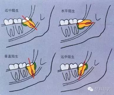 口腔拔牙图片,口腔拔牙麻醉多久消退
