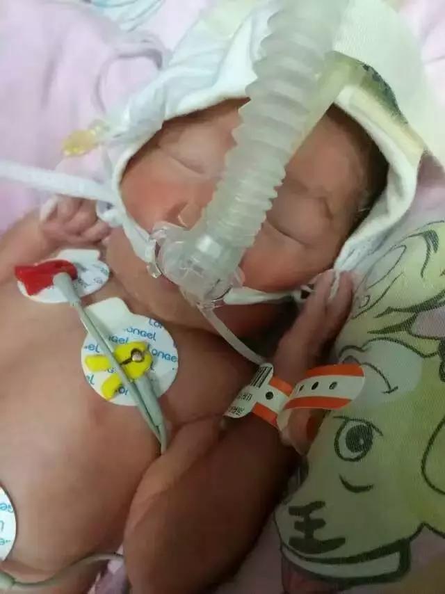 老公在外面签字保我，我在里面签字保孩子：31孕周早产儿妈妈凶险性前置胎盘并大出血，休克2次，子宫摘除