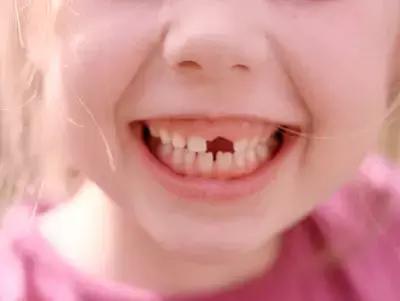 牙齿楔状缺损疼痛怎么办,儿童牙齿有缺损怎么治疗