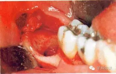 口腔拔牙图片,口腔拔牙麻醉多久消退