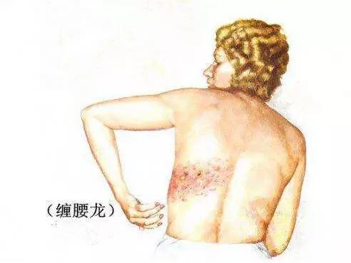蛇串疮西医病名,蛇串疮医术专长综述范文