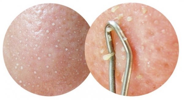 脸上白白的有点像粉刺又不是粉刺,脸上长粉刺的原因和改善方法