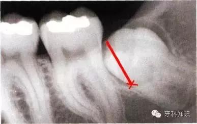 口腔拔牙图片,口腔拔牙麻醉多久消退