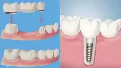 牙齿楔状缺损疼痛怎么办,儿童牙齿有缺损怎么治疗