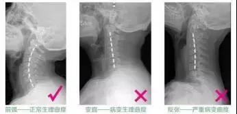 张景明讲颈椎病怎么锻炼,钟南山院士讲治疗颈椎病视频