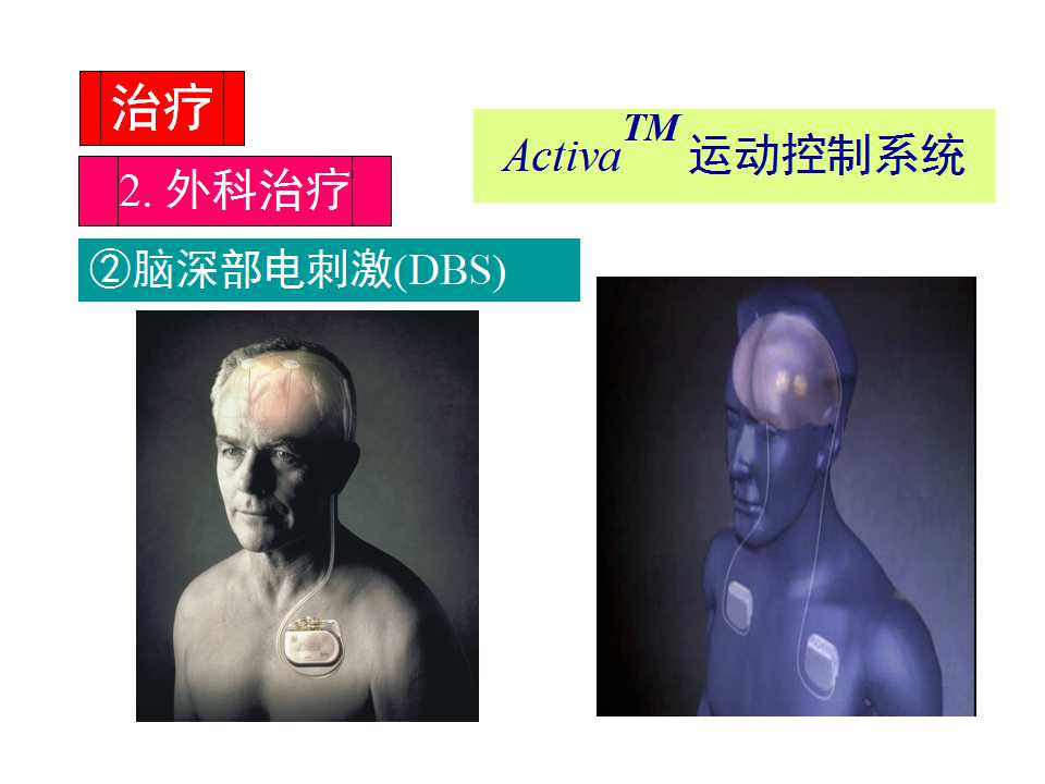 多图详解帕金森及运动障碍性疾病|关于帕金森最全的一个课件